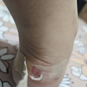 Yeni Alınan Ayakkabı Çocuğumun Ayağında Derin Yaralar Oluşturdu