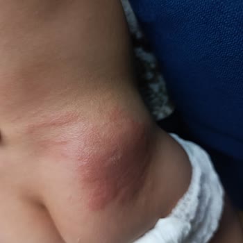 Molfix Bebek Bezi Cilt Sorunları Ve Kimyasal Koku Şikayeti