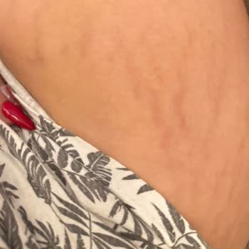 Yanlış Uygulama Sonrası Kalıcı İzler Ve Psikolojik Travma: Striort Tedavisi Hayatımı Olumsuz Etkiledi