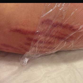 Yanlış Uygulama Sonrası Kalıcı İzler Ve Psikolojik Travma: Striort Tedavisi Hayatımı Olumsuz Etkiledi