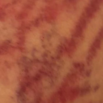 Yanlış Uygulama Sonrası Kalıcı İzler Ve Psikolojik Travma: Striort Tedavisi Hayatımı Olumsuz Etkiledi