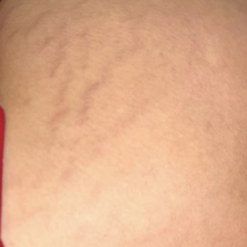 Yanlış Uygulama Sonrası Kalıcı İzler Ve Psikolojik Travma: Striort Tedavisi Hayatımı Olumsuz Etkiledi