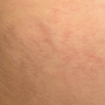 Yanlış Uygulama Sonrası Kalıcı İzler Ve Psikolojik Travma: Striort Tedavisi Hayatımı Olumsuz Etkiledi