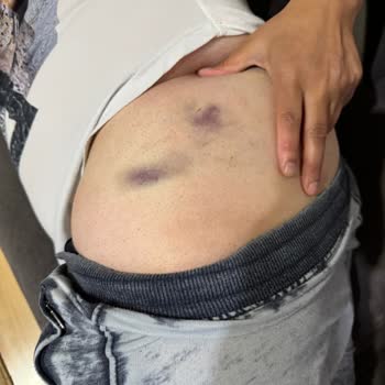 Enjeksiyon Sonrası Morarma Ve İlgisiz Davranış