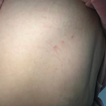 Duru Body Scrub Sonrası Şiddetli Kaşıntı Şikayeti