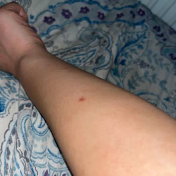 Duru Body Scrub Sonrası Şiddetli Kaşıntı Şikayeti