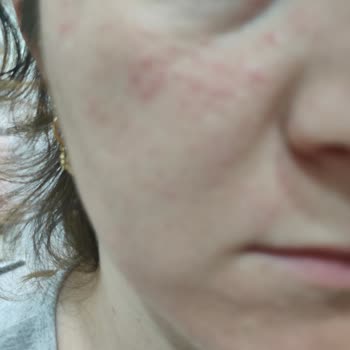 Sinoz Pink Touch Sivilce Yaptı