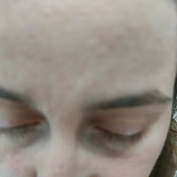 Sinoz Pink Touch Sivilce Yaptı