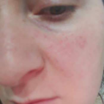 Sinoz Pink Touch Sivilce Yaptı