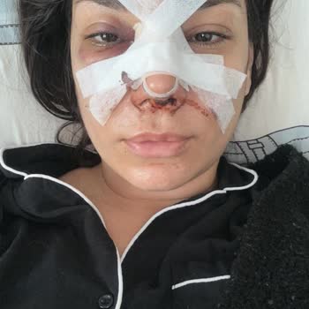 Dr. Levent Ateş Burun Ameliyatı Pişmanlığı