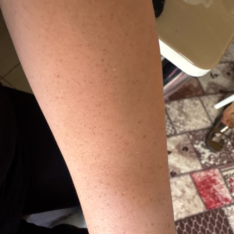 Şanlıurfa Şubesinde Bilgisiz Ve İlgisiz Lazer Epilasyon Deneyimi