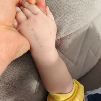 Başarılı Sünnet, Başarısız Anestezi Girişimiyle Gölgede Kaldı