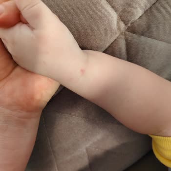 Başarılı Sünnet, Başarısız Anestezi Girişimiyle Gölgede Kaldı