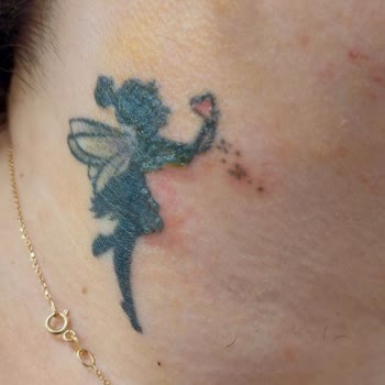 Lazer Uygulamasında Dikkatsizlik Yüzünden Dövmem Yandı, İlgisiz Personel Mağdur Etti