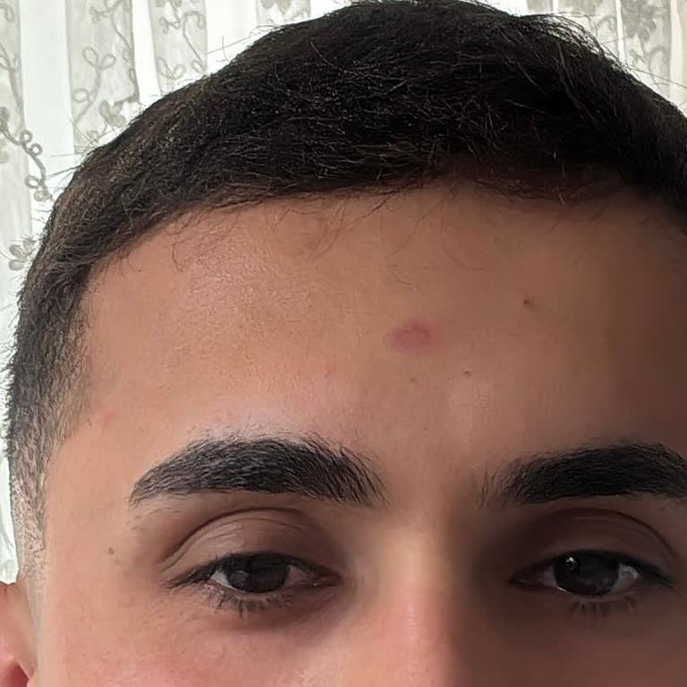 Lazer Sonrası Yüz Yanığına Çözüm Bulunmuyor, İlgisizlik Mağdur Ediyor