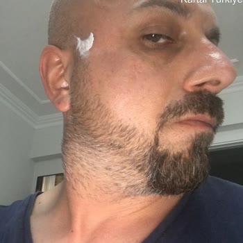 Rayban Gözlükte Pas Ve Kabarma Nedeniyle Sağlık Sorunu Yaşadım