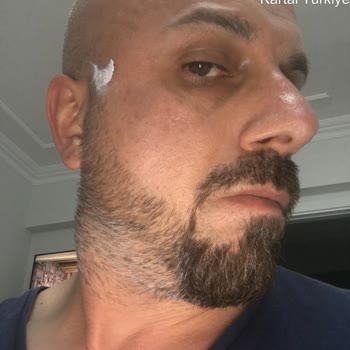 Rayban Gözlükte Pas Ve Kabarma Nedeniyle Sağlık Sorunu Yaşadım