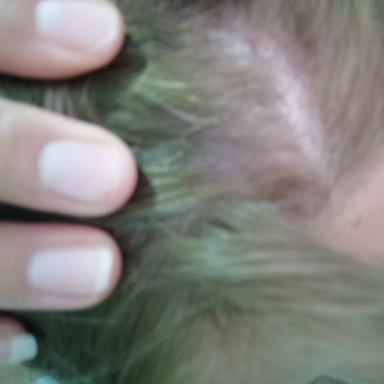 Saç İşlemi Sonrası Yaşanan Mağduriyet Ve İlgisizlik