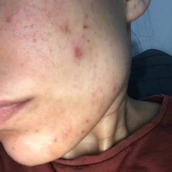 Bioderma Ürünleri Cildimde Sivilceye Sebep Oldu