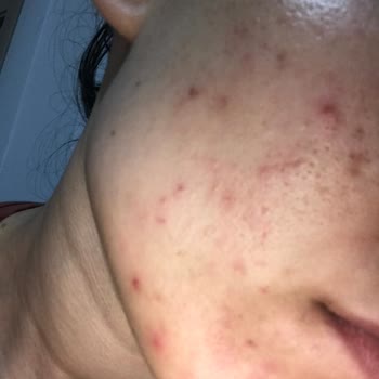 Bioderma Ürünleri Cildimde Sivilceye Sebep Oldu