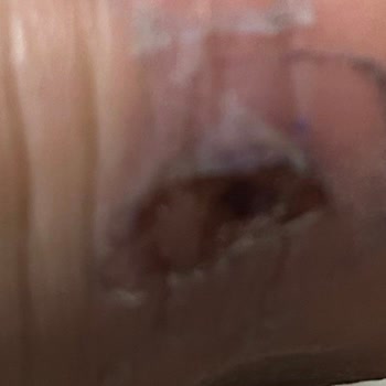 Aldığım Ayakkabı Ayağımı Yaraladı, İade Veya Değişim Talebim Reddedildi