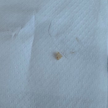 Hamburgerde Kıl Ve İlgisiz Personel Deneyimi