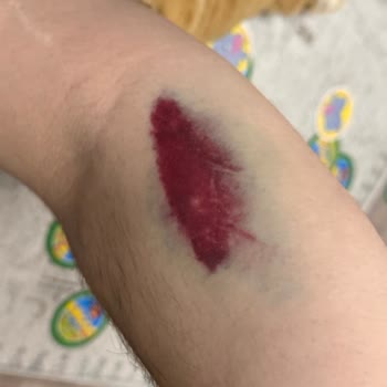 Medistate Kavacık Hastanesinde Damar Yolu Açma Ve İletişimde Ciddi Sorunlar Yaşadık