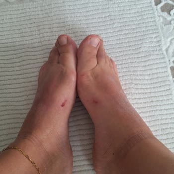 Ceyo Terlikler Ayaklarımızı Yaraladı, Tatilimiz Zehir Oldu