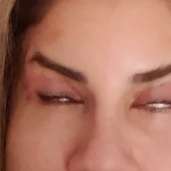 Ameliyat Sonrası Göz Simetrisi Ve İz Problemi