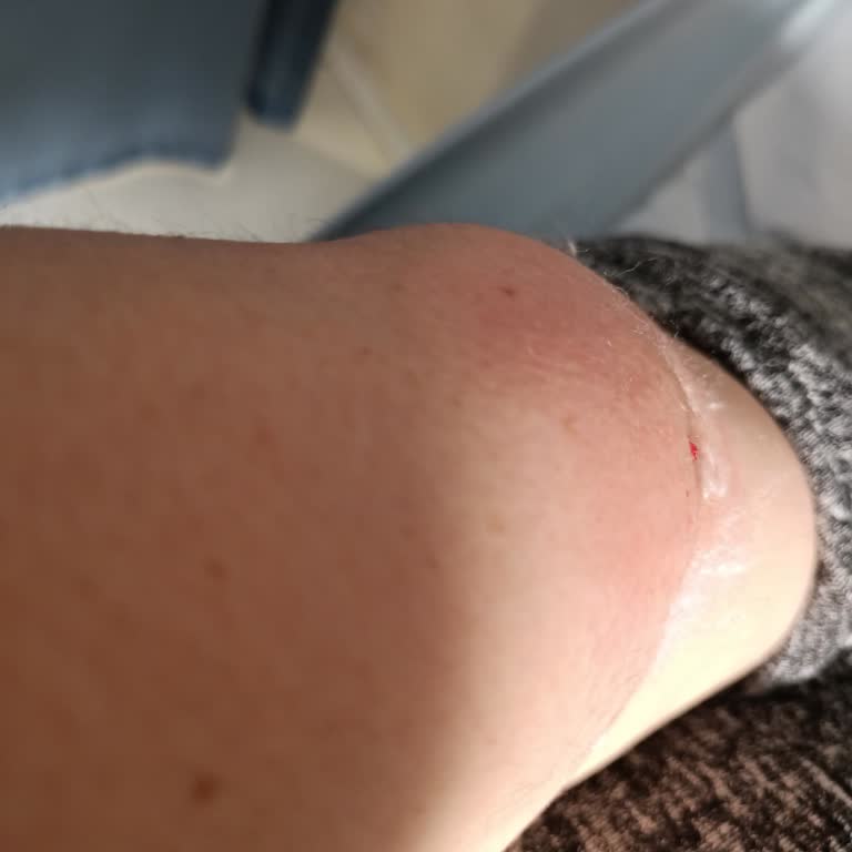 Hemşirelerin İlgisizliği Ve Ağrıya Duyarsız Yaklaşımı Hasta Mağduriyetine Yol Açtı