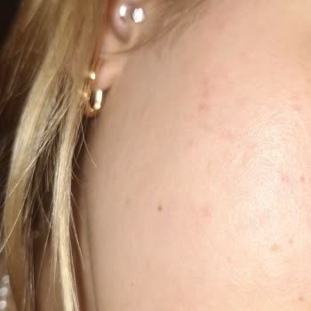 Nemlendirici Ve Güneş Kremi Sonrası Cildimde Ciddi Sorunlar Yaşadım