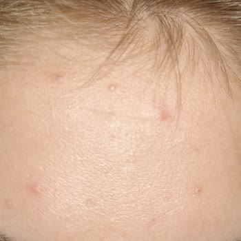 Nemlendirici Ve Güneş Kremi Sonrası Cildimde Ciddi Sorunlar Yaşadım