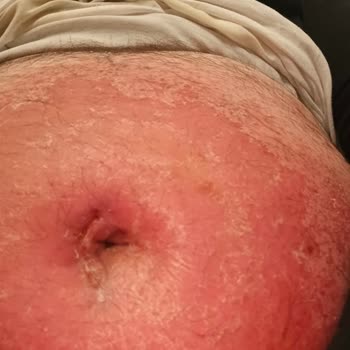 Ameliyat Sonrası Merhem Alerjisi Ve Yetersiz Doktor Yönlendirmesi