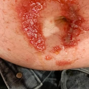 Ameliyat Sonrası Merhem Alerjisi Ve Yetersiz Doktor Yönlendirmesi