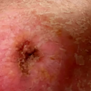 Ameliyat Sonrası Merhem Alerjisi Ve Yetersiz Doktor Yönlendirmesi