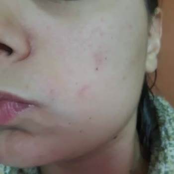 Güneş Kremi Sonrası Yüzümde Egzama Benzeri Yaralar Oluştu