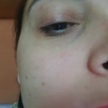 Güneş Kremi Sonrası Yüzümde Egzama Benzeri Yaralar Oluştu