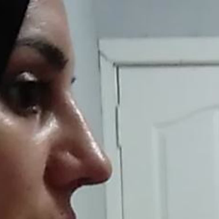 Op. Dr. Onur Nursaçan Ameliyat Sonrası Burnum Daha Kötü Hale Geldi, Psikolojim Bozuldu