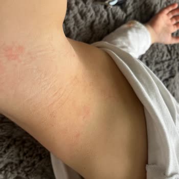 Sleepy Altı Numara Bez Alerji Yaptı, Mağduriyet Yaşadım