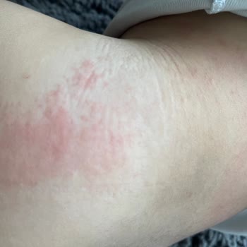 Sleepy Altı Numara Bez Alerji Yaptı, Mağduriyet Yaşadım