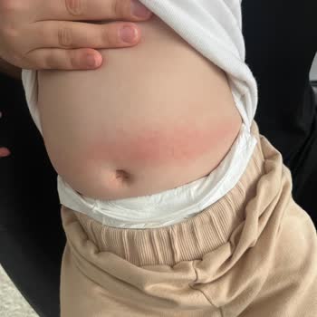 Sleepy Altı Numara Bez Alerji Yaptı, Mağduriyet Yaşadım