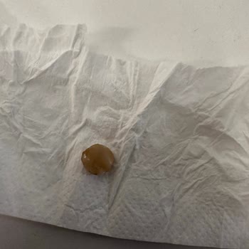 Lokumdan Çıkan Ağaç Parçası Dişimi Mahvetti, Kimse Dönmüyor!