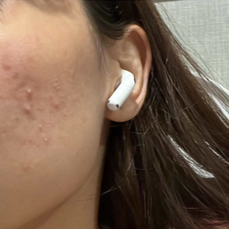 Yves Rocher Nemlendirici Yüzümde Sivilce Ve Kaşıntı Yaptı