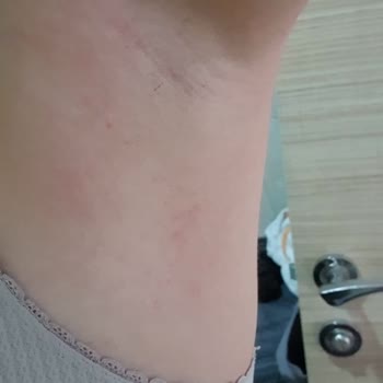 Rexona Deodorant Ciddi Alerjik Reaksiyon Ve Dayanılmaz Kaşıntı Yaşattı
