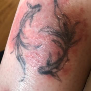 ED Clinique Lazer Epilasyonunda Yetersiz Personel Ve Ciddi Yanık Deneyimi