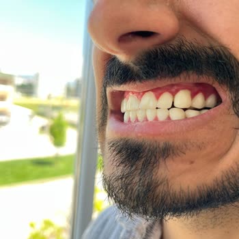 Diş Tedavisi Sonrası Sürekli Sorunlar Ve Memnuniyetsizlik