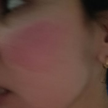 Aldığım Maske Cildimi Mahvetti, Acile Gitmek Zorunda Kaldım