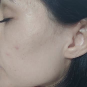 Yves Rocher Bright Botanical Face Cream Gave Me Painful, Long-Lasting Acne