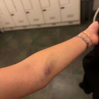 Kan Alımı Sonrası Kolum Şişti Ve Morardı, Hatanın Kabul Edilmemesi Üzdü