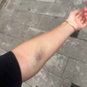 Kan Alımı Sonrası Kolum Şişti Ve Morardı, Hatanın Kabul Edilmemesi Üzdü